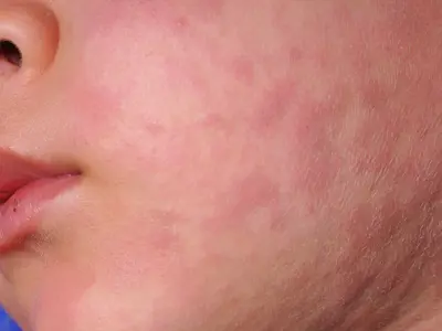 childs face with red rash